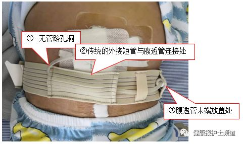 为什么要加热输血儿科护士发明家又有创新了！小发明，大作用！快来围观呀！_https://www.jmylbn.com_新闻资讯_第5张