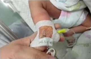 留置针怎么贴胶带医用透气胶带在儿科留置针中的使用_https://www.jmylbn.com_新闻资讯_第4张