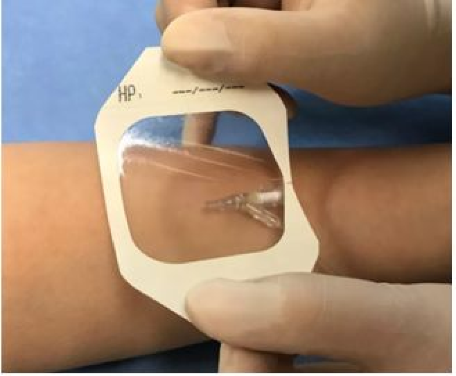 留置针怎么贴胶带医用透气胶带在儿科留置针中的使用_https://www.jmylbn.com_新闻资讯_第2张