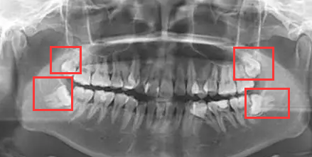智齿到底要不要拔？你该做决定了！