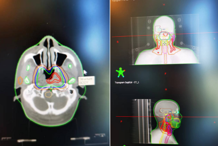 放疗怎么定位【健康科普】放疗小百科：定位篇_https://www.jmylbn.com_新闻资讯_第7张