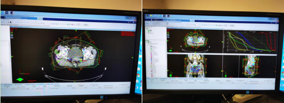 放疗怎么定位【健康科普】放疗小百科：定位篇_https://www.jmylbn.com_新闻资讯_第8张