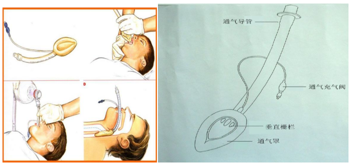 喉罩是什么【宣教】关于喉罩的那些事_https://www.jmylbn.com_新闻资讯_第7张