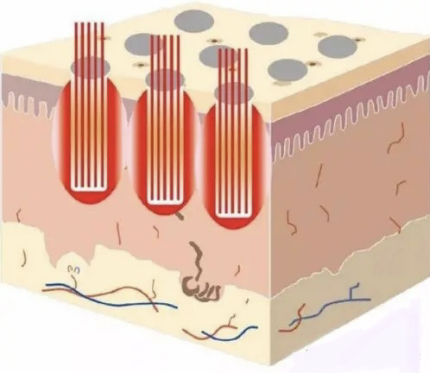 二氧化碳(co2)激光治疗是什么【宣教】点阵式CO2激光——针对您私密处烦恼的好帮手_https://www.jmylbn.com_新闻资讯_第1张