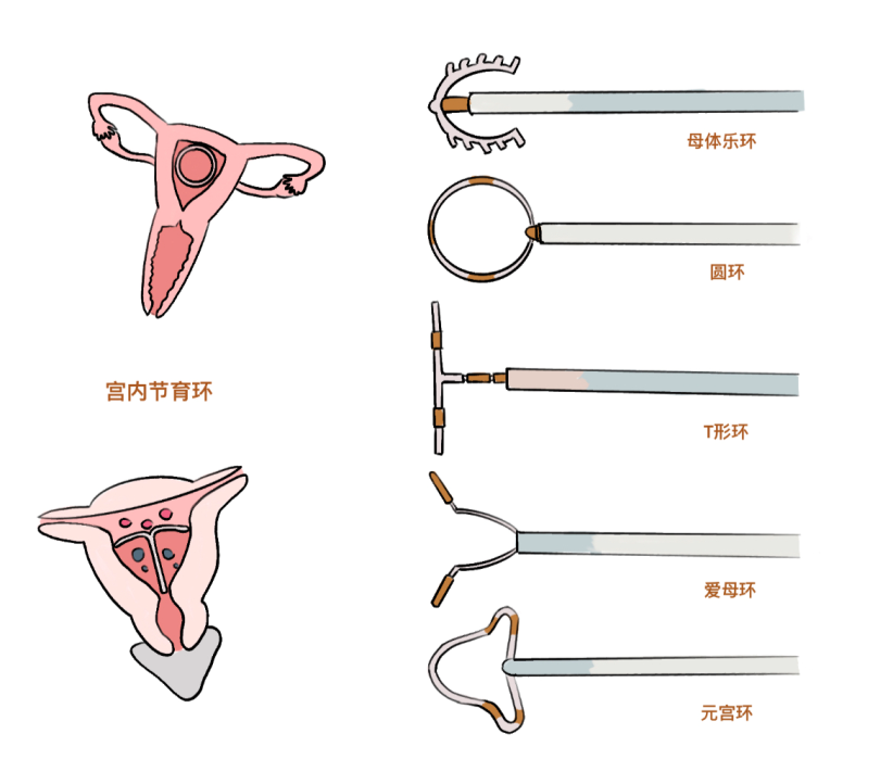 【宣教】你不知道的节育环上环全攻略！