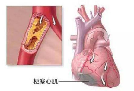 台灣作家林清玄去世病因也是突發心梗，這些心梗常識必須知道！ 健康 第2張