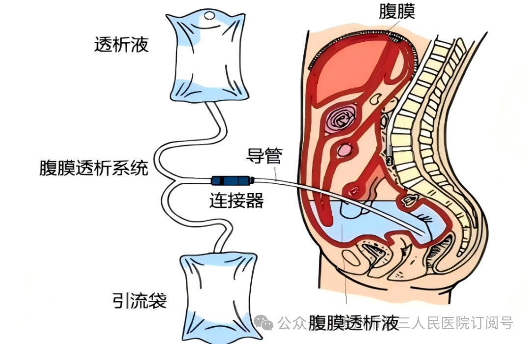 腹膜透析示意图