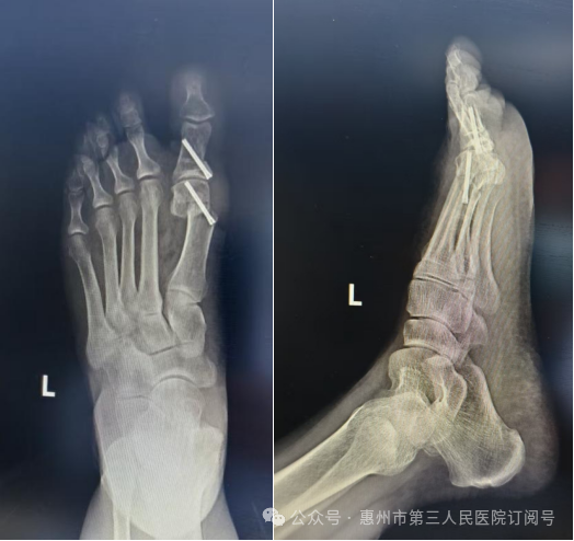 术后X线片