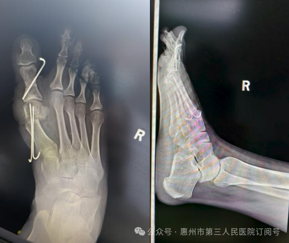 术后