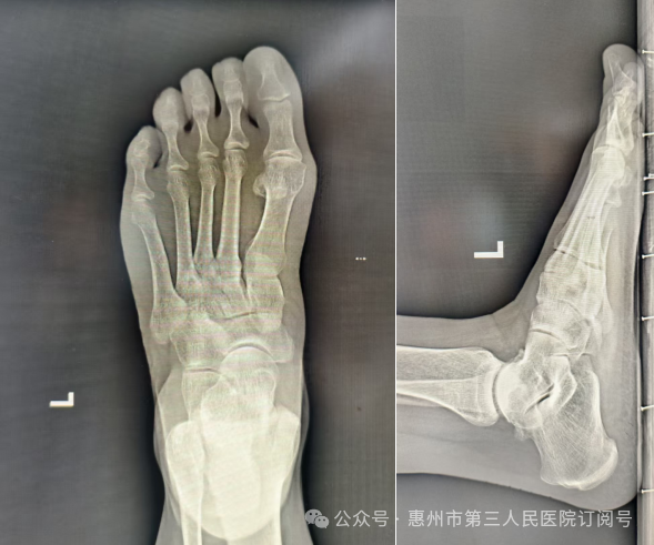 术前X线片