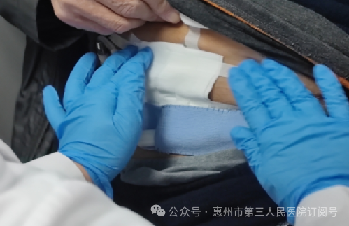 腹透导管口护理