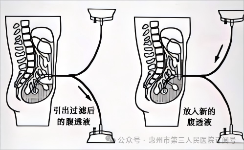 腹膜透析操作原理