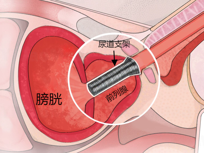尿道支架植入前列腺示意图