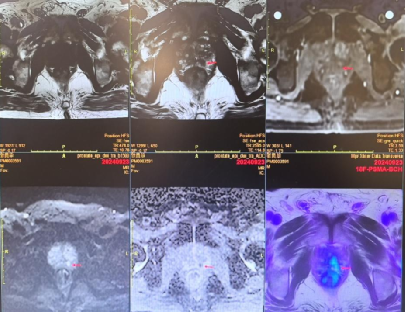张叔术前MRI