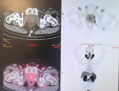 张叔术前PET-CT
