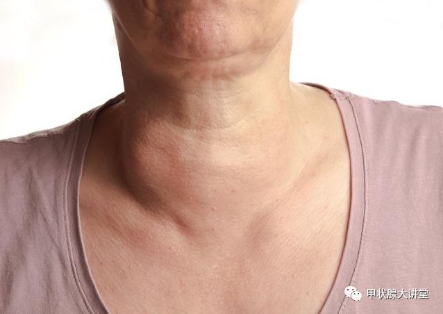 符合这几点可诊断为甲减性心脏病|健康教育 - 核医学科 - 科室导航