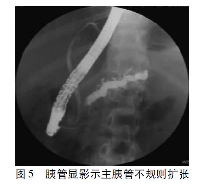 慢性胰腺炎診治指南（2018，廣州） 健康 第5張