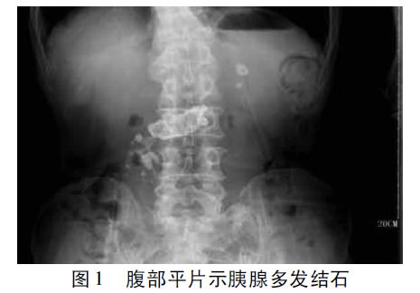 慢性胰腺炎診治指南（2018，廣州） 健康 第2張