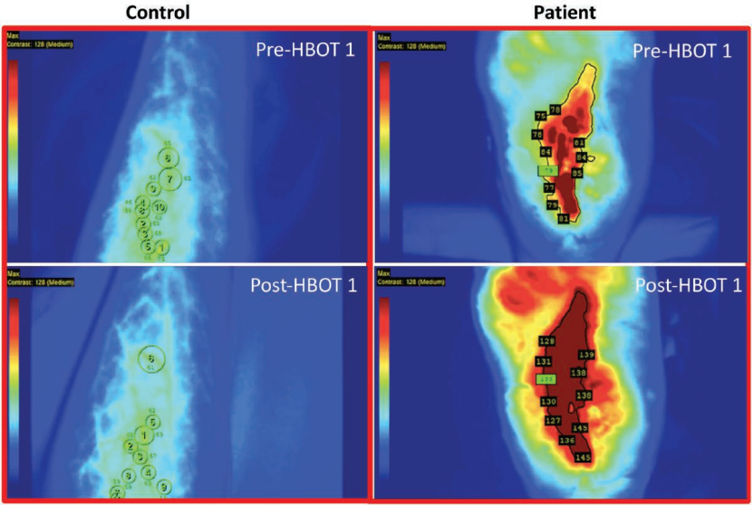 什么是经皮氧分压小编深聊高压氧在慢性创面和糖尿病足应用_https://www.jmylbn.com_新闻资讯_第3张
