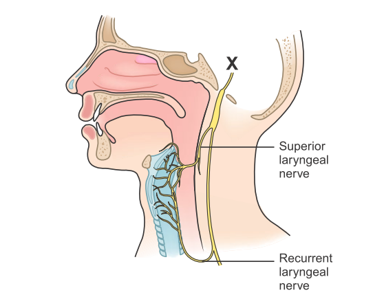 可视喉申请怎么清醒患者气管插管技术，急诊医生必知！_https://www.jmylbn.com_新闻资讯_第5张