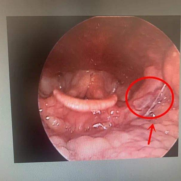 为什么我做喉镜没有麻醉为啥医生总让我做电子喉镜_https://www.jmylbn.com_新闻资讯_第2张