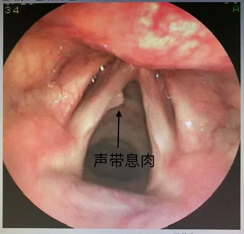 为什么我做喉镜没有麻醉为啥医生总让我做电子喉镜_https://www.jmylbn.com_新闻资讯_第6张