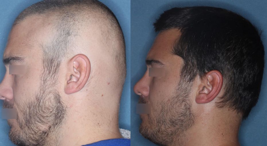 JAK抑制剂治疗斑秃二期临床试验效果图