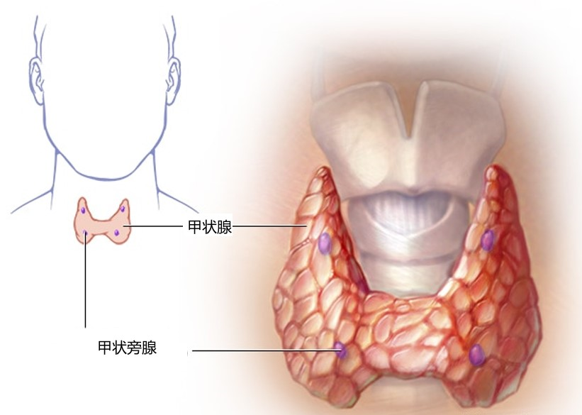 6969原发性甲状旁腺功能亢进(phpt)是高钙血症最常见的原因,由一
