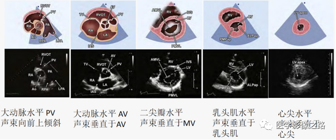 什么叫超声容积探头医学超声影像学笔记——心脏正常的解剖和超声评价_https://www.jmylbn.com_新闻资讯_第7张