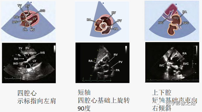 什么叫超声容积探头医学超声影像学笔记——心脏正常的解剖和超声评价_https://www.jmylbn.com_新闻资讯_第9张