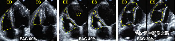 什么叫超声容积探头医学超声影像学笔记——心脏正常的解剖和超声评价_https://www.jmylbn.com_新闻资讯_第16张