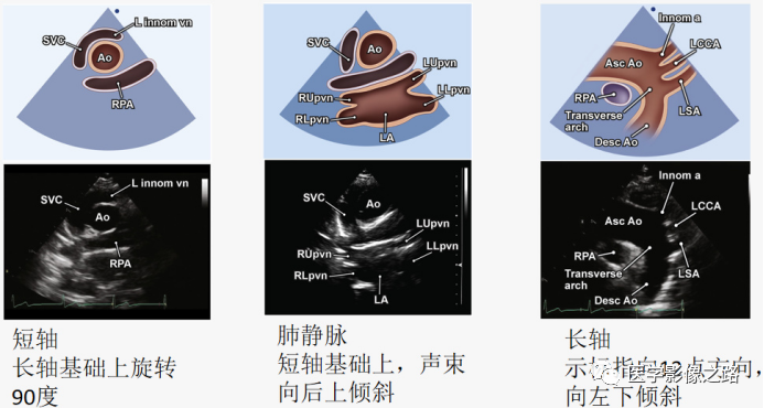 什么叫超声容积探头医学超声影像学笔记——心脏正常的解剖和超声评价_https://www.jmylbn.com_新闻资讯_第10张