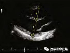 什么叫超声容积探头医学超声影像学笔记——心脏正常的解剖和超声评价_https://www.jmylbn.com_新闻资讯_第11张