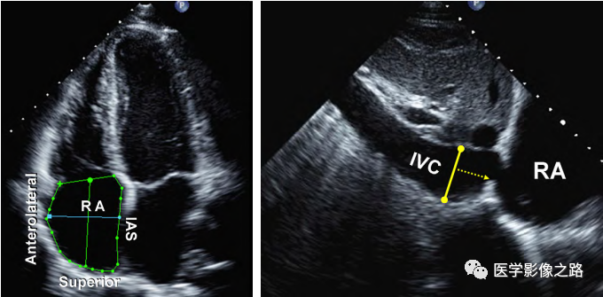 什么叫超声容积探头医学超声影像学笔记——心脏正常的解剖和超声评价_https://www.jmylbn.com_新闻资讯_第17张