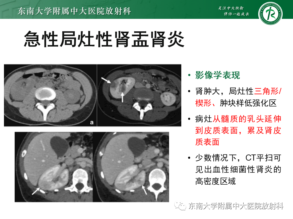 肾盂CT图片