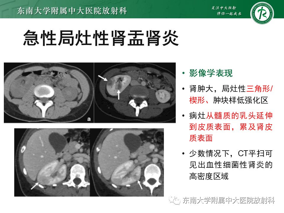 腎盂腎炎的影像表現_醫學界-助力醫生臨床決策和職業成長