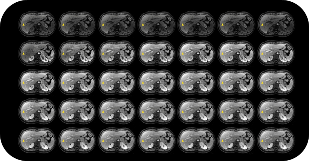 磁共振矩阵怎么计算【重磅】新一代智慧型生命感知磁共振——MAGNETOM Vida， 成功落户中大放射并全面投入使用！！！_https://www.jmylbn.com_新闻资讯_第11张