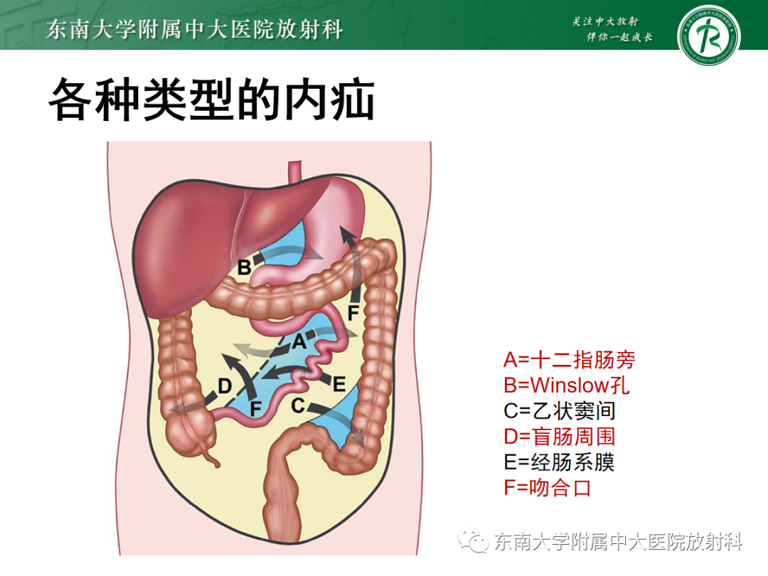 绞窄性小肠梗阻不可忽视的原因——腹内疝影像诊断_医学界-助力医生