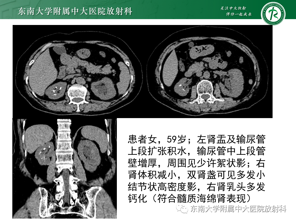 肾结核_医学界-助力医生临床决策和职业成长