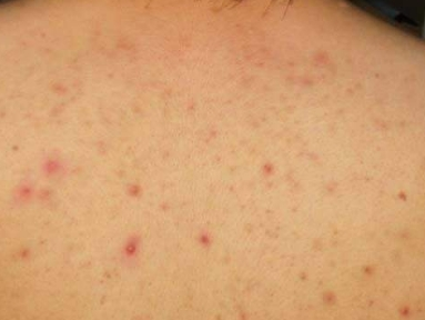 毛囊发炎的原因有哪些，大腿毛囊炎怎么治？