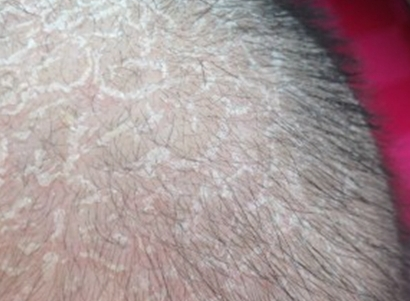 头癣是怎么产生的，如何鉴别三种头癣