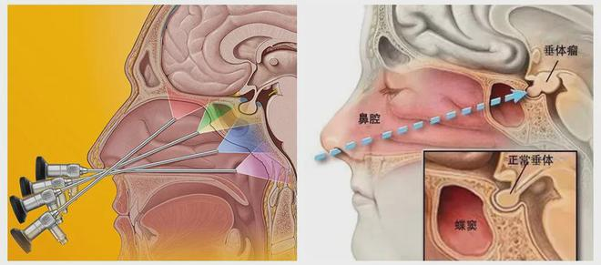 手术垂体瘤费用多少_后悔做垂体瘤手术了_后悔手术瘤垂体做手术好吗