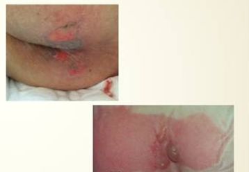 性敷料是什么压力性损伤（压疮）不同分期的敷料选择_https://www.jmylbn.com_新闻资讯_第3张