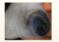 性敷料是什么压力性损伤（压疮）不同分期的敷料选择_https://www.jmylbn.com_新闻资讯_第15张