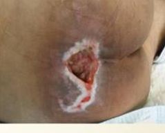 性敷料是什么压力性损伤（压疮）不同分期的敷料选择_https://www.jmylbn.com_新闻资讯_第5张