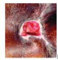 性敷料是什么压力性损伤（压疮）不同分期的敷料选择_https://www.jmylbn.com_新闻资讯_第4张