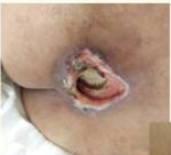 性敷料是什么压力性损伤（压疮）不同分期的敷料选择_https://www.jmylbn.com_新闻资讯_第6张