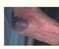 性敷料是什么压力性损伤（压疮）不同分期的敷料选择_https://www.jmylbn.com_新闻资讯_第9张