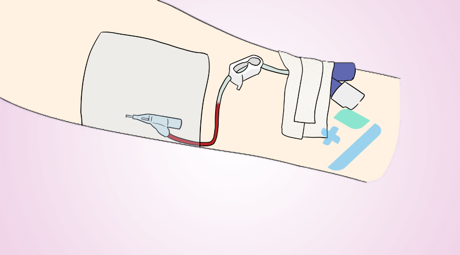 留置针都有哪些厂家80%的护士都不知道：静脉留置输液竟有这么多问题？_https://www.jmylbn.com_新闻资讯_第7张