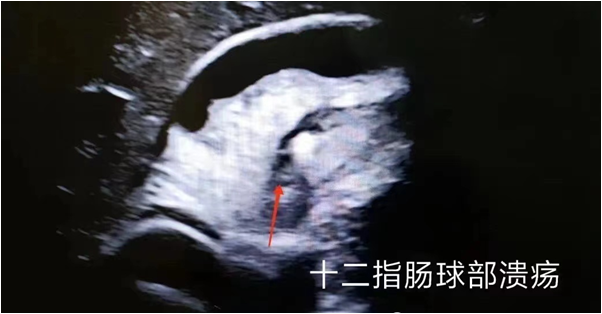 胃造影用的是什么机子胃肠检查的新技术、新突破——胃肠充盈超声造影_https://www.jmylbn.com_新闻资讯_第8张